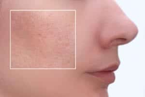 nitric oxide helps prevent clogged pores