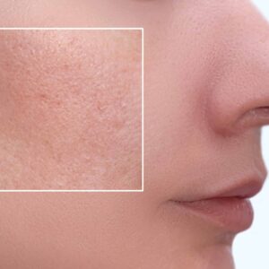 nitric oxide helps prevent clogged pores