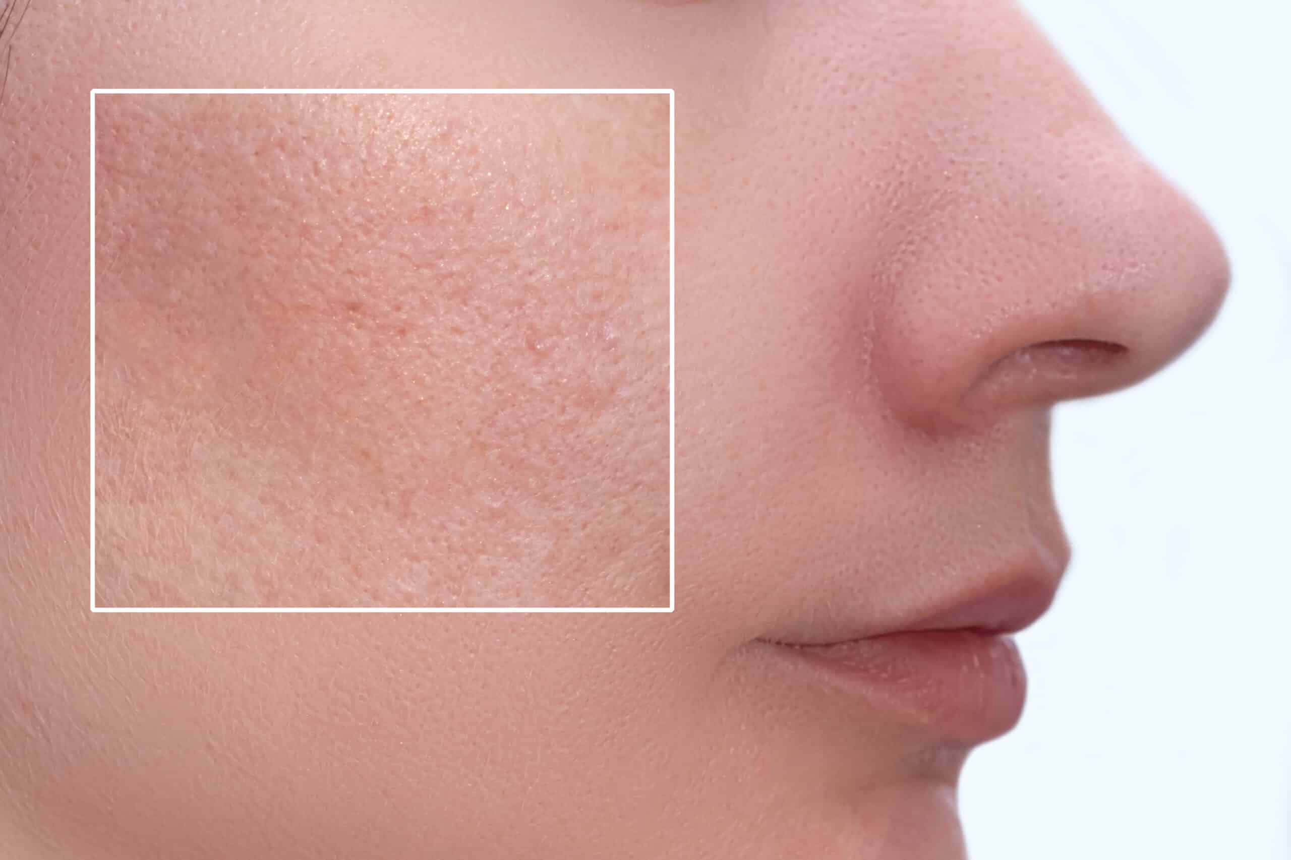 nitric oxide helps prevent clogged pores