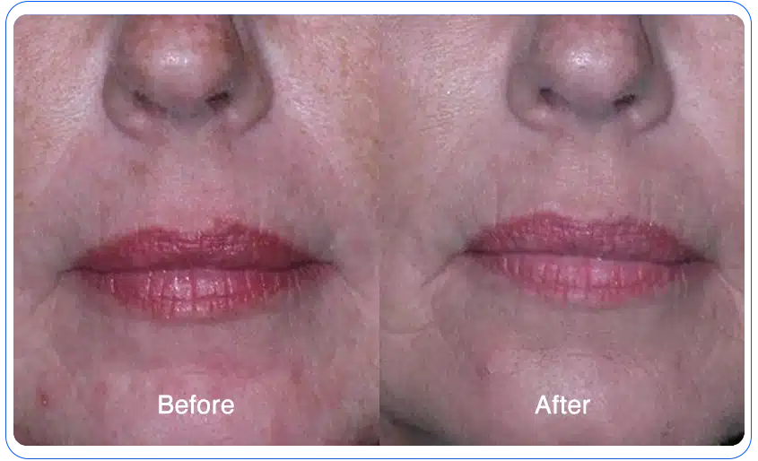 n1o1 before after 04