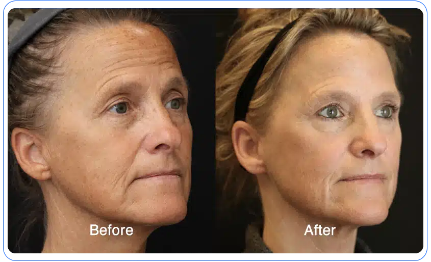 n1o1 before after 06