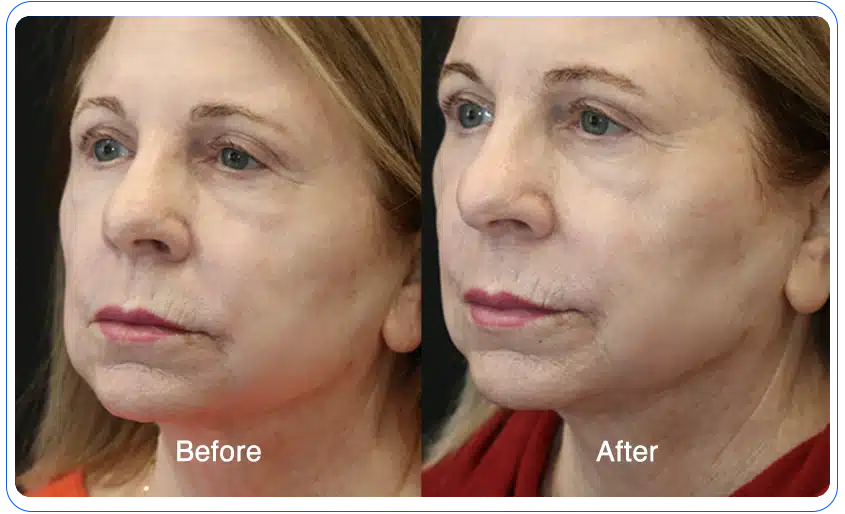 n1o1 before after 08