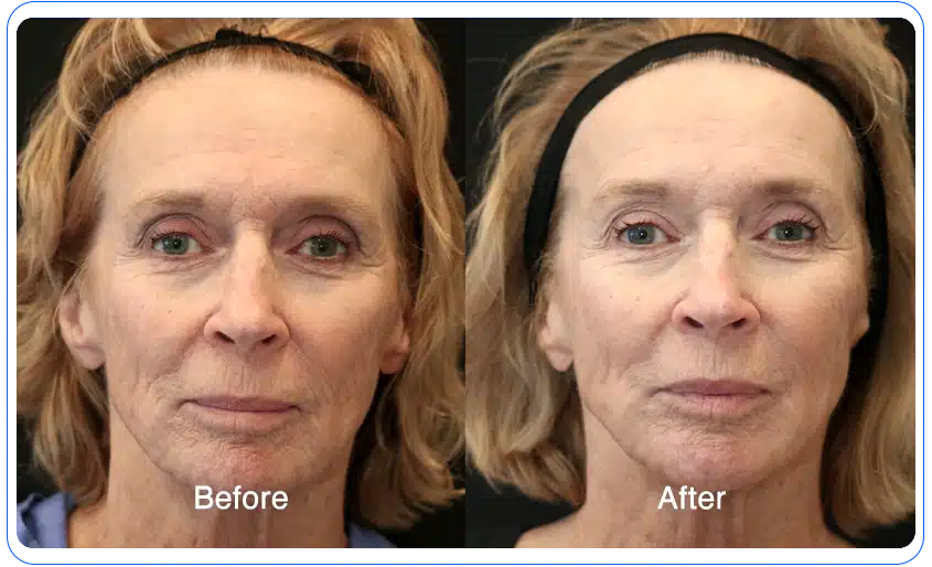 n1o1 before after 10