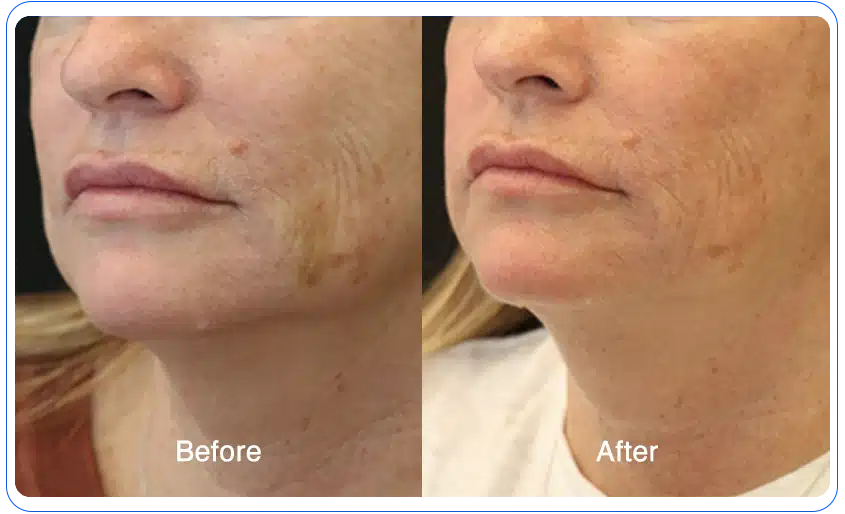 n1o1 before after 11