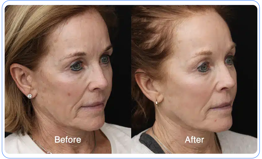 n1o1 before after 12