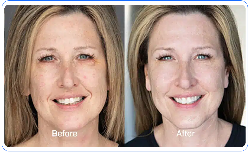 n1o1 before after 13 1