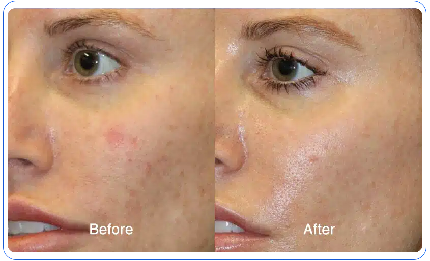 n1o1 before after 14