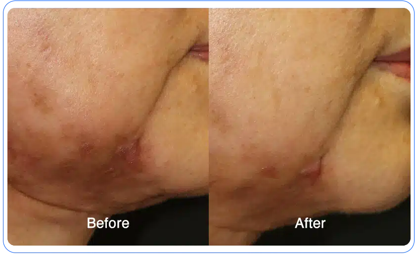n1o1 before after 15