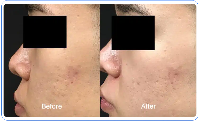 n1o1 before after 17