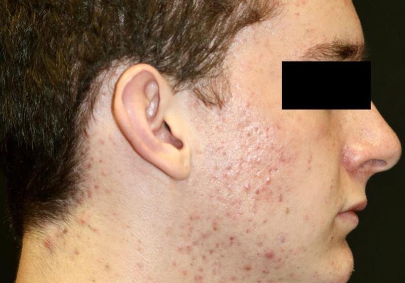 13 AfterAcne scaled 1 landscape