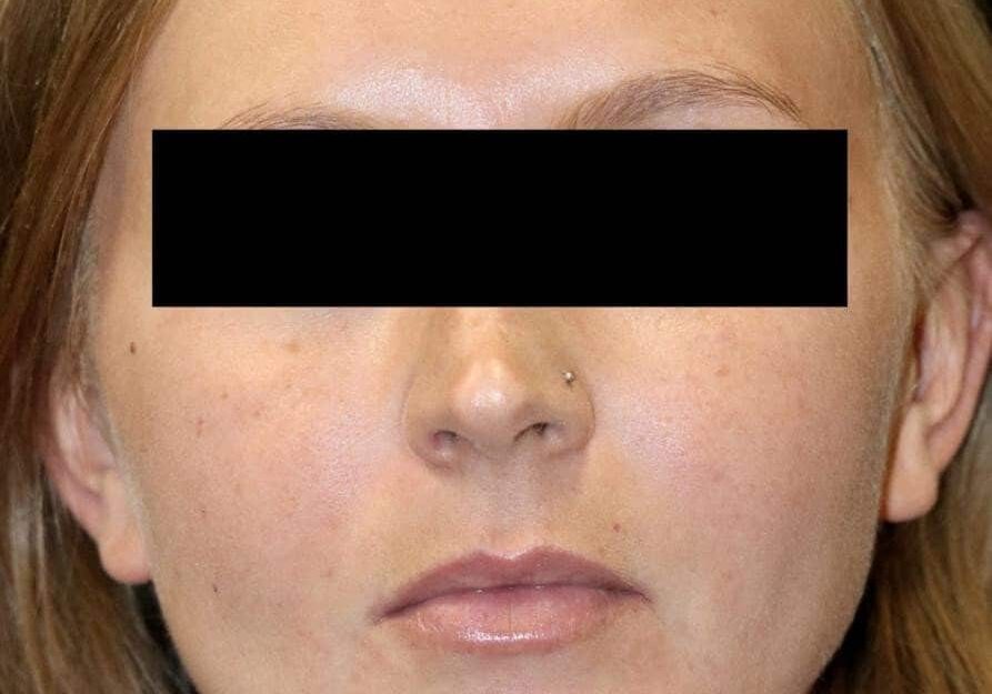 19 AfterAcne scaled 1 landscape