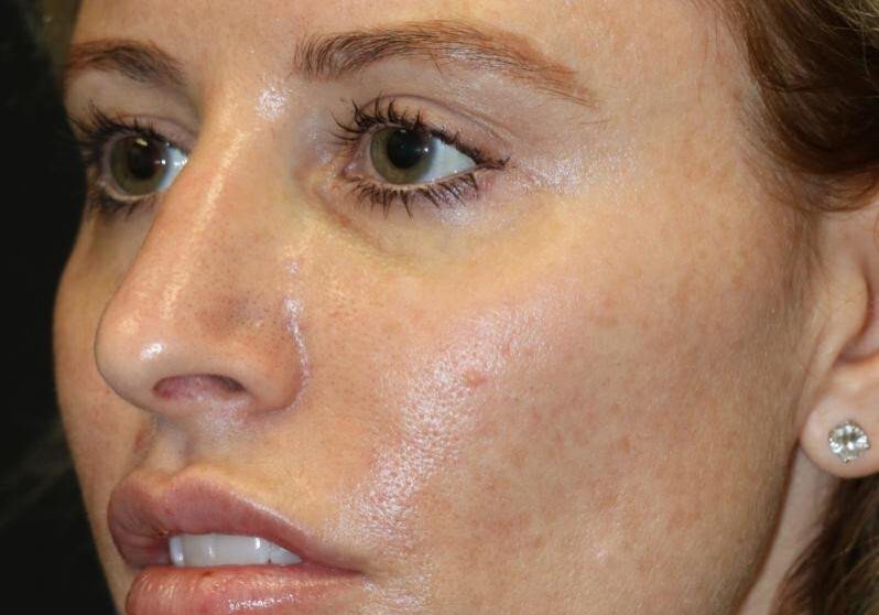 20e AfterAcne scaled 1 landscape
