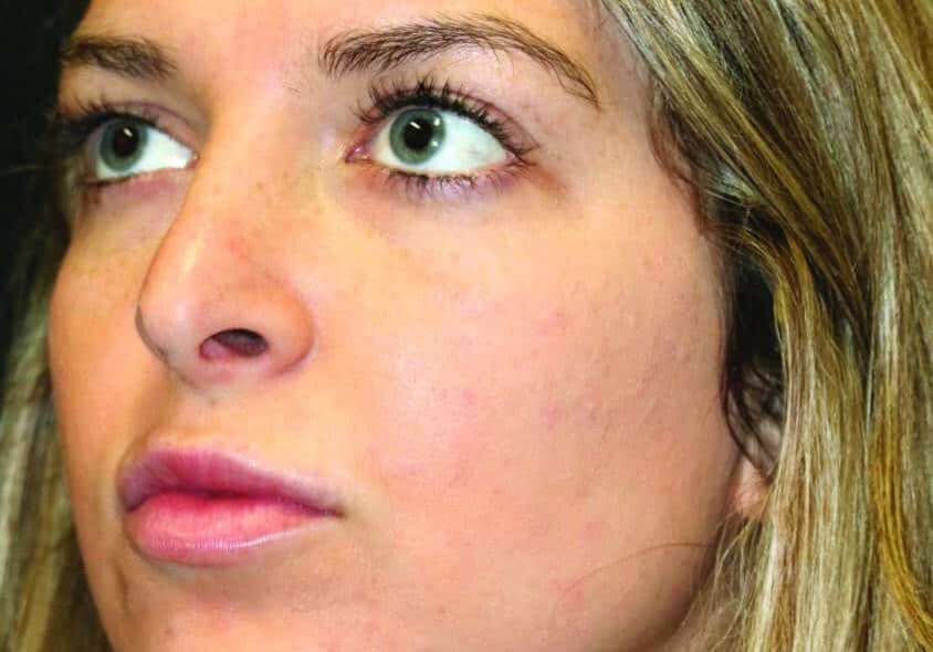 7 AfterAcne scaled 1 landscape