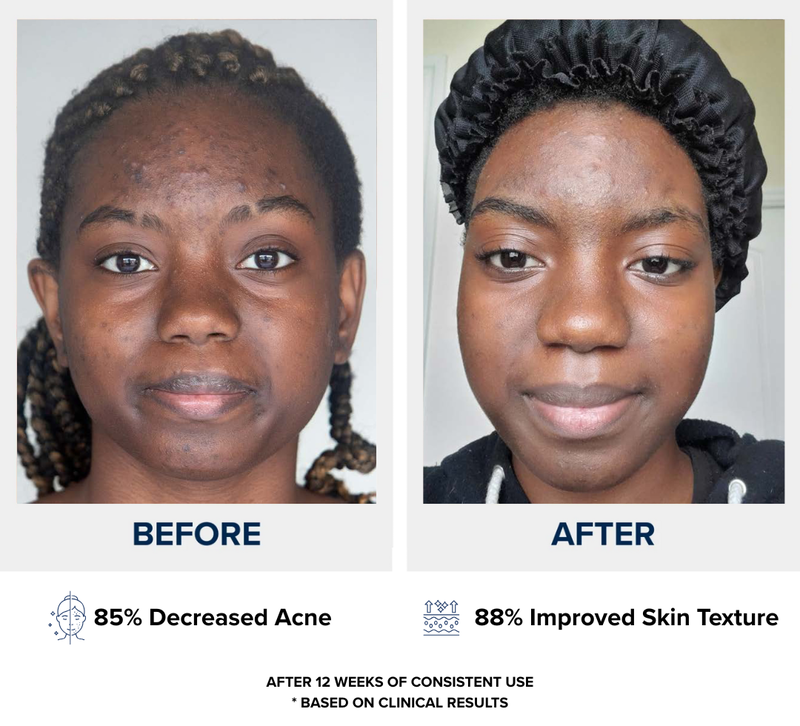 n1o1 nitric oxide - before after - decreased acne
