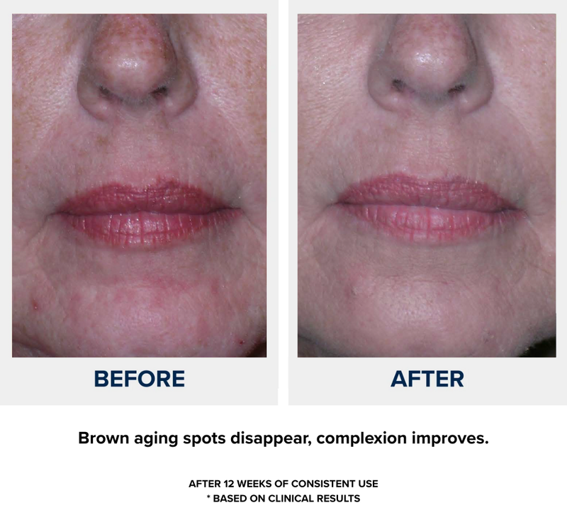n1o1 nitric oxide - before after - decreased age spots