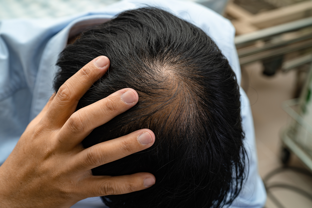 balding